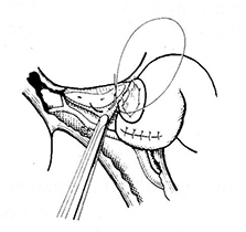 世界中で今も選択される「Kasais’ Procedure」(葛西術式)