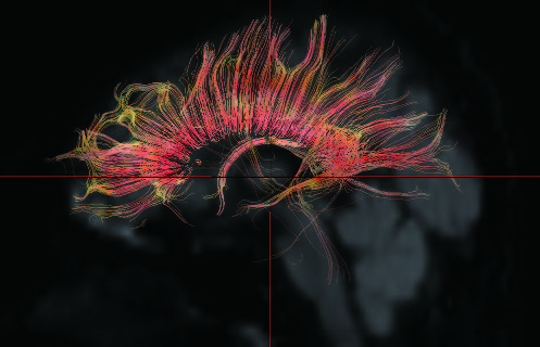 Figure 2. Diffusion tensor imaging