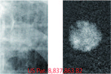 Figure 2. Novel intelligent fluoroscopic imaging: Tumor extraction (right) from the X-ray image (left)
