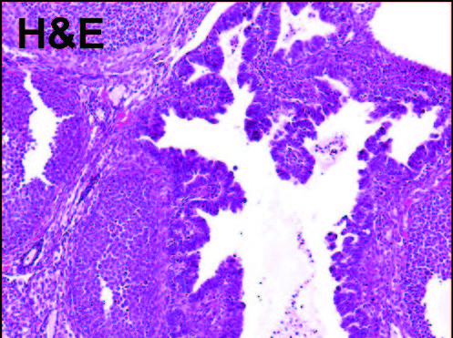 Figure 2. Invasive serous carcinoma of the ovary of mOGP-Tag transgenic mice