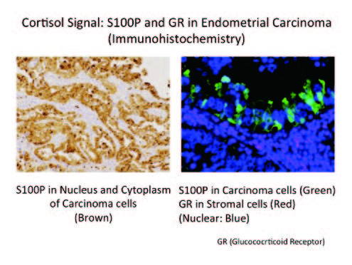 Figure 1. Cortisol signal: S100P and GR in endometrial carcinoma