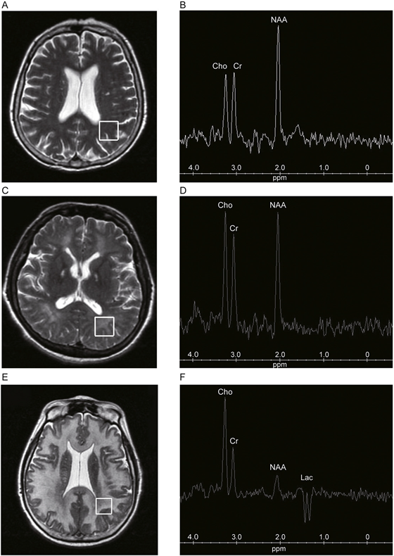 Figure 2. Alteration of 1H-MRS parameters in patients with drug intoxication